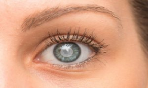 Cataracts