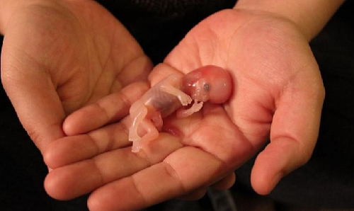 Miscarriage